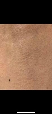 After photo of underarm sugaring hair removal.
Lasts 2-3 weeks