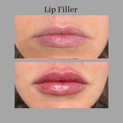 Lip filler by our nurse practitioner