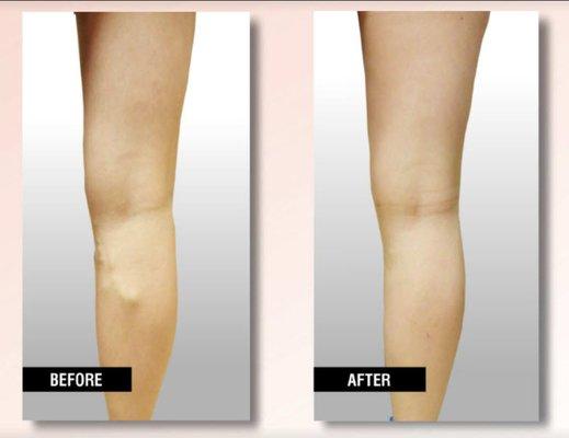 Before and After Vein Treatment