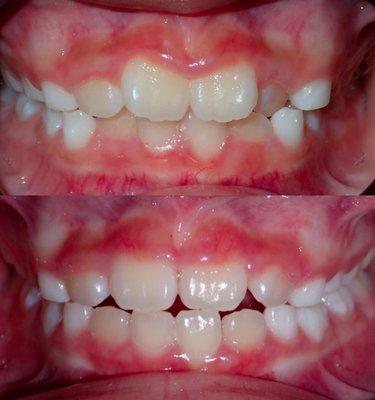 Myofunctional appliances are more holistic, less invasive, less painful, and less expensive alternative to braces.