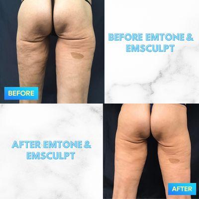 Before and after 8 EMTONE cellulite reduction treatments and 4 EMSCULPT body contouring treatments.