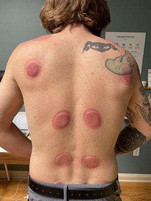 Cupping