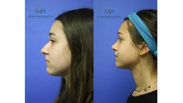 Rhinoplasty Before and After