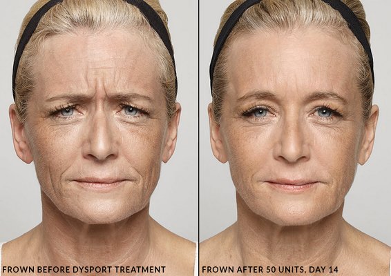 Get Dysport® treatment to temporarily remove wrinkles!