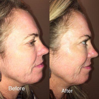 Dermaplane before and after