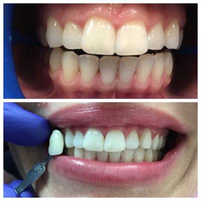 Zoom Whitening