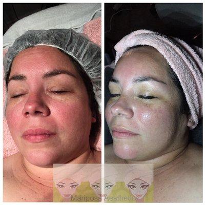 Rosacea correction