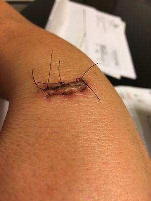 Obviously this looks ANGRY.. I'm even more angry that you won't take these stitches out!