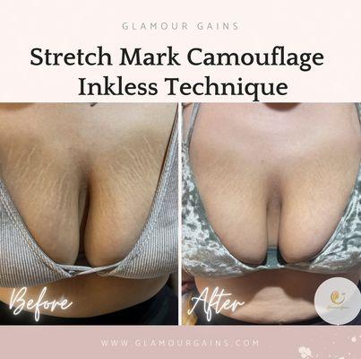 Bye bye stretch marks