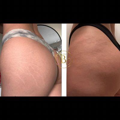 Inkless Stretch Mark Rejuvenation- Appearance and texture of stretch marks greatly reduced after one session.