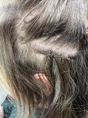 Incorrectly installed extensions that was causing headache, blisters, and scalp irritation.