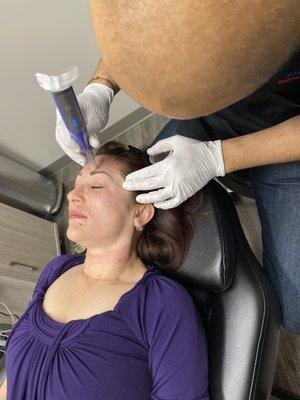 Microneedling