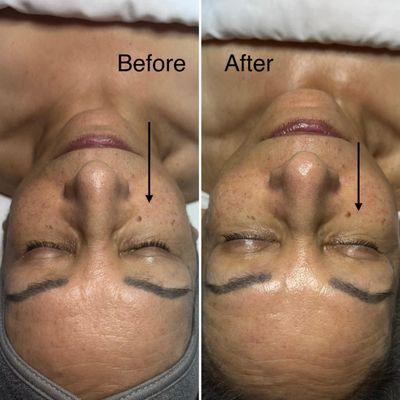 Hydro facial 
Before and after 3 treatments