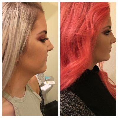 Before and after! Beautiful chin transformation after 6 sessions