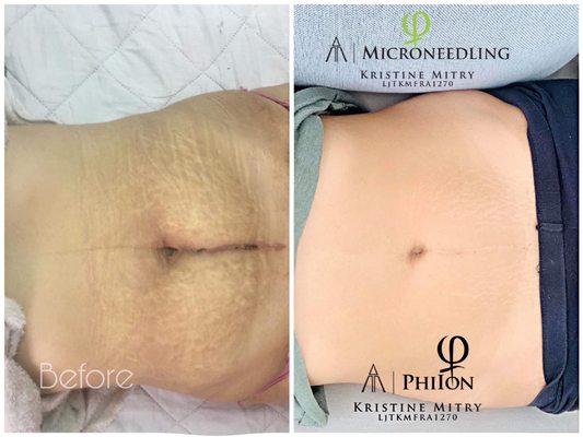 Tummy tuck with 1 plasma ion and 6 Microneedling.