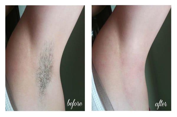 Waxing the underarms eliminates the dark stubble common with shaving. Redness subsides in a few hours.