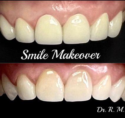 Your old crowns or veneers  can be replace with esthetic ones!