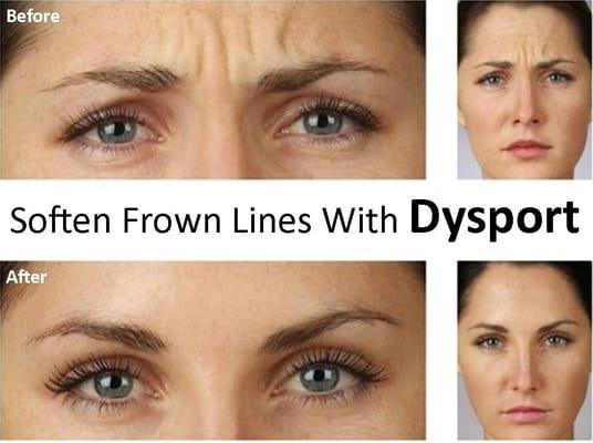 For temporary improvement of moderate to severe frown lines between the eyebrows forehead wrinkles, and crow's feet.