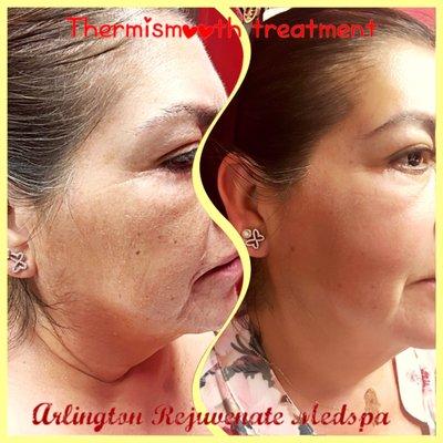 Thermismooth treatment-non invasive skin tightening, dark pigmentation and wrinkle reduction, pores smaller, facial rejuvenation treatment