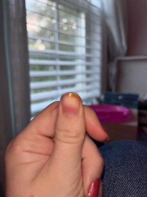 nail fungus