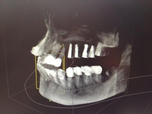 Affordable Quality Advanced Dental Implant