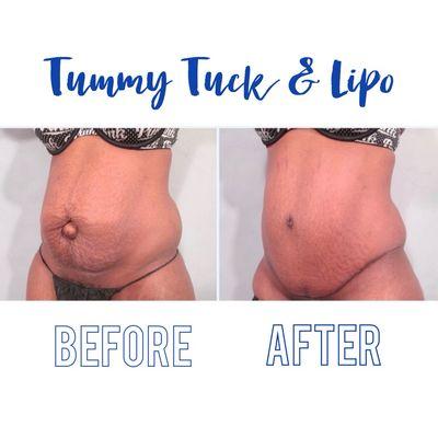 Tummy Tuck & Liposuction Procedure