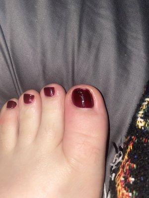 Red infected toe and chipped polish