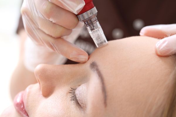 We offer microneedling treatments, also known as collagen induction therapy.