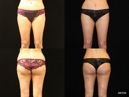 58 YEAR OLD WOMAN, 5'4", 123 LBS, LIPOSUCTION, FAT TRANSFER, ORANGE COUNTY, CA