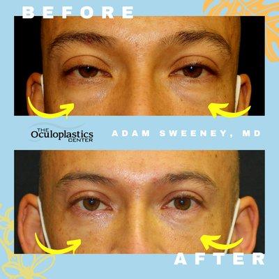 Before and after lower lid blepharoplasty surgery to correct for lower lid bags