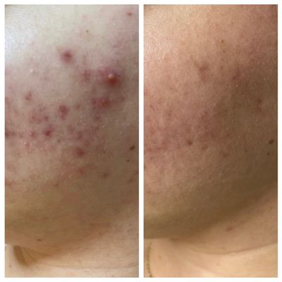 Acne treatment!! Results from combination treatments- 4 months.