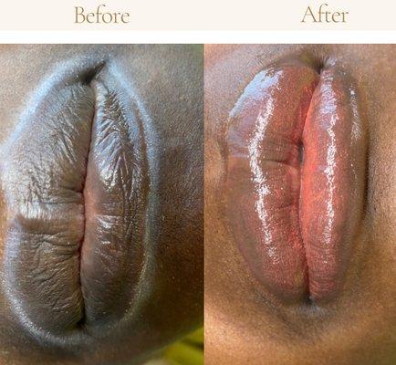 Lip Neutralization. Gives lips a more balanced and flesh toned appearance. Multiple appointments required, based on the amount of melanin.