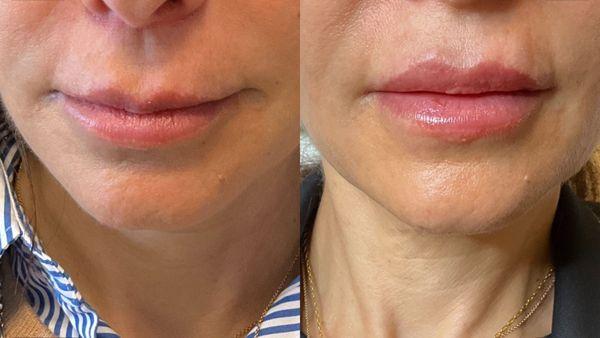 Lip Filler by Yulia Baevski, RN. Lip improvement with Juvederm Volbella at Trifecta Med Spa.