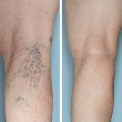 Before and after: spider vein removal results. We offer a variety of FDA-approved spider vein treatments, including vein laser!