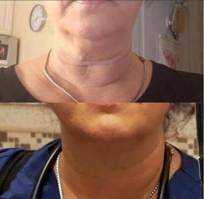 PDO Thread Neck Lift