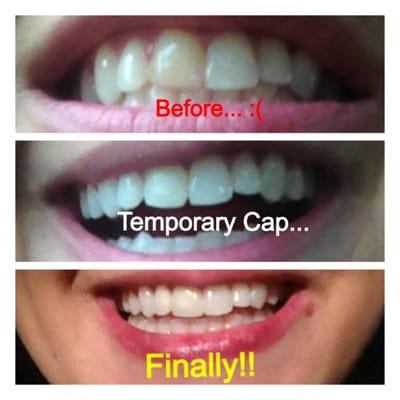 I chipped my front left front tooth when I was 11 years old. The original work was a temporary bonding. Final work is a crown.