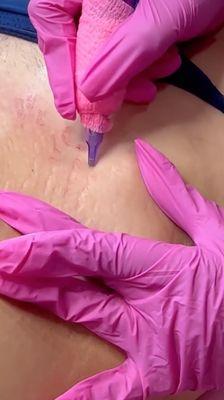 Ink-less Stretch Marks Repair