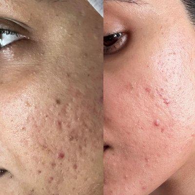 Acne treatment progress