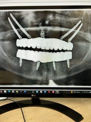 Zygoma implants. Teeth in a day. Happy patient. Back to smiling again!!!