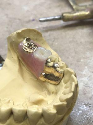 Pure Gold Partial Denture