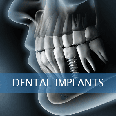 Dr. Ibarra is placing dental implants at our office .