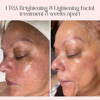 Brightening skin treatments to help improve skin tone and clarity