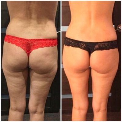 Cellulite treatment