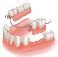 Removable partial denture replaces missing teeth.