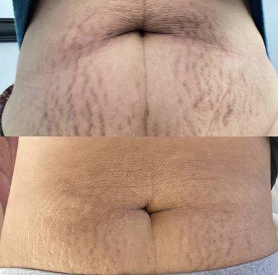 Brazilian inkless stretch mark removal treatment