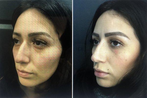 Non-surgical rhinoplasty