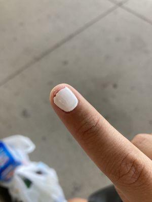 Injured nail