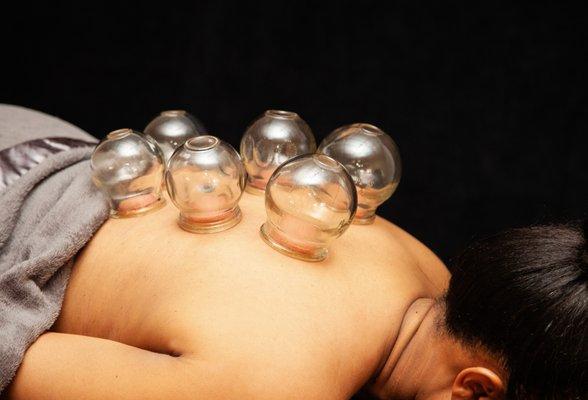 Cupping Therapy