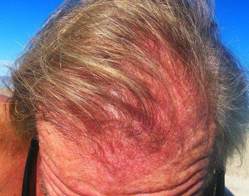 SERVERLY DAMAGED SCALP from chemicals  Noggins Hair Salon Havasu