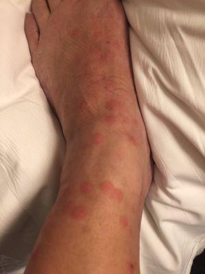 Flea bites from one night at the hotel